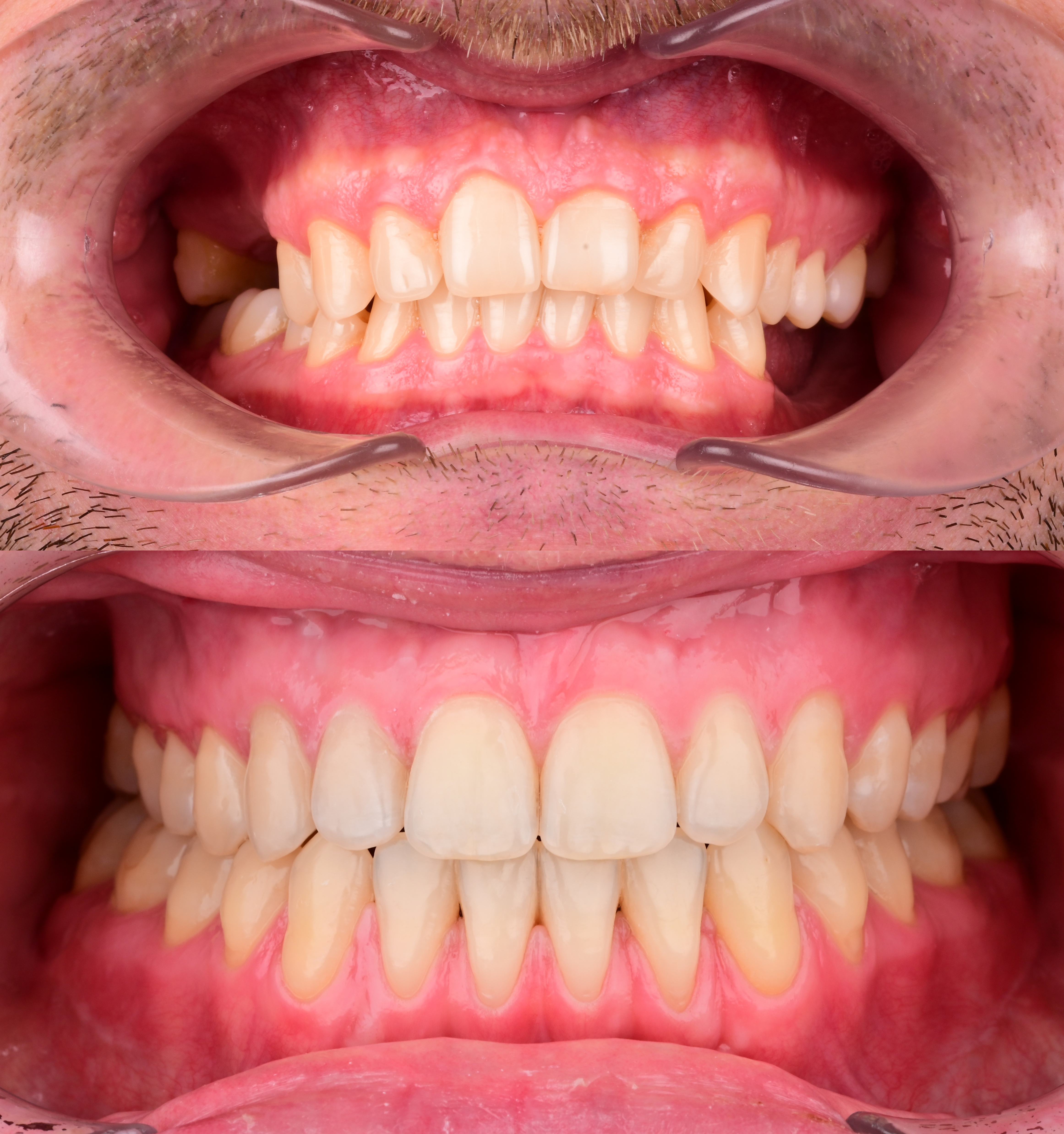 Коррекция дистального прикуса и протрузии на верхней челюсти. Закрытие промежутков от отсутствующих 3.6, 4.6 с целью избежания протезирования.