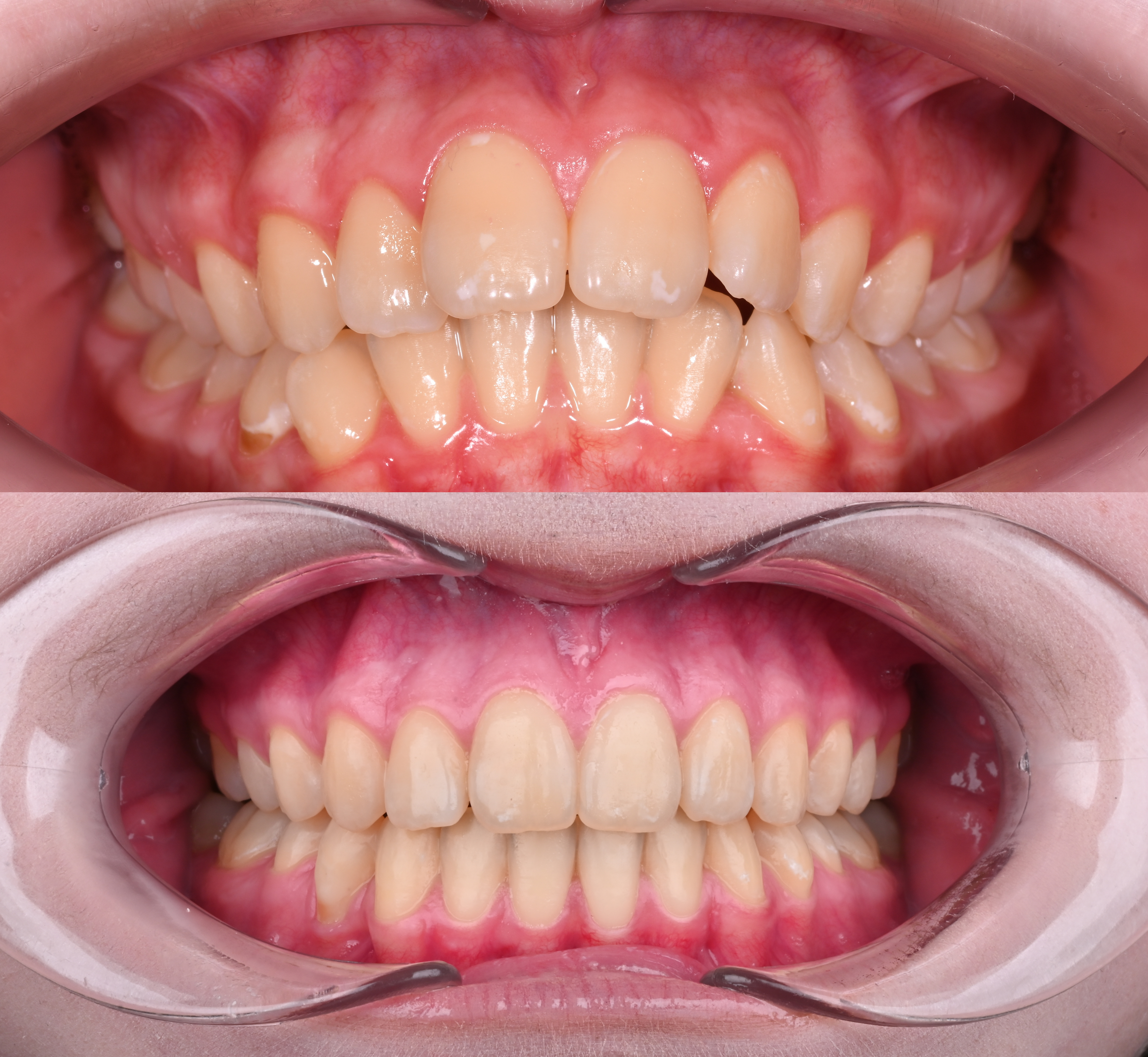 Коррекция обратной арки улыбки, выраженной глубокой шпее на нижней челюсти