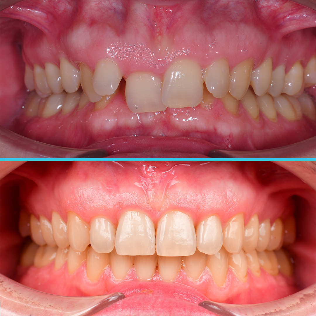 Лечение дистопии зубов у взрослого пациента