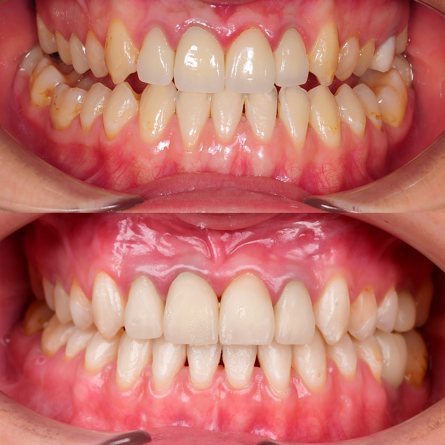 Лечение скелетной формы мезиального смыкания с проведением ортогнатической двучелюстной хирургической операции с гениопластикой