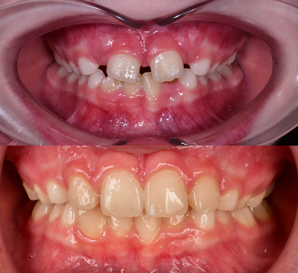 Частичное лечение на брекет-системе в детском возрасте для снижения риска травматизации постоянных зубов и решения дефицита места для их прорезывания
