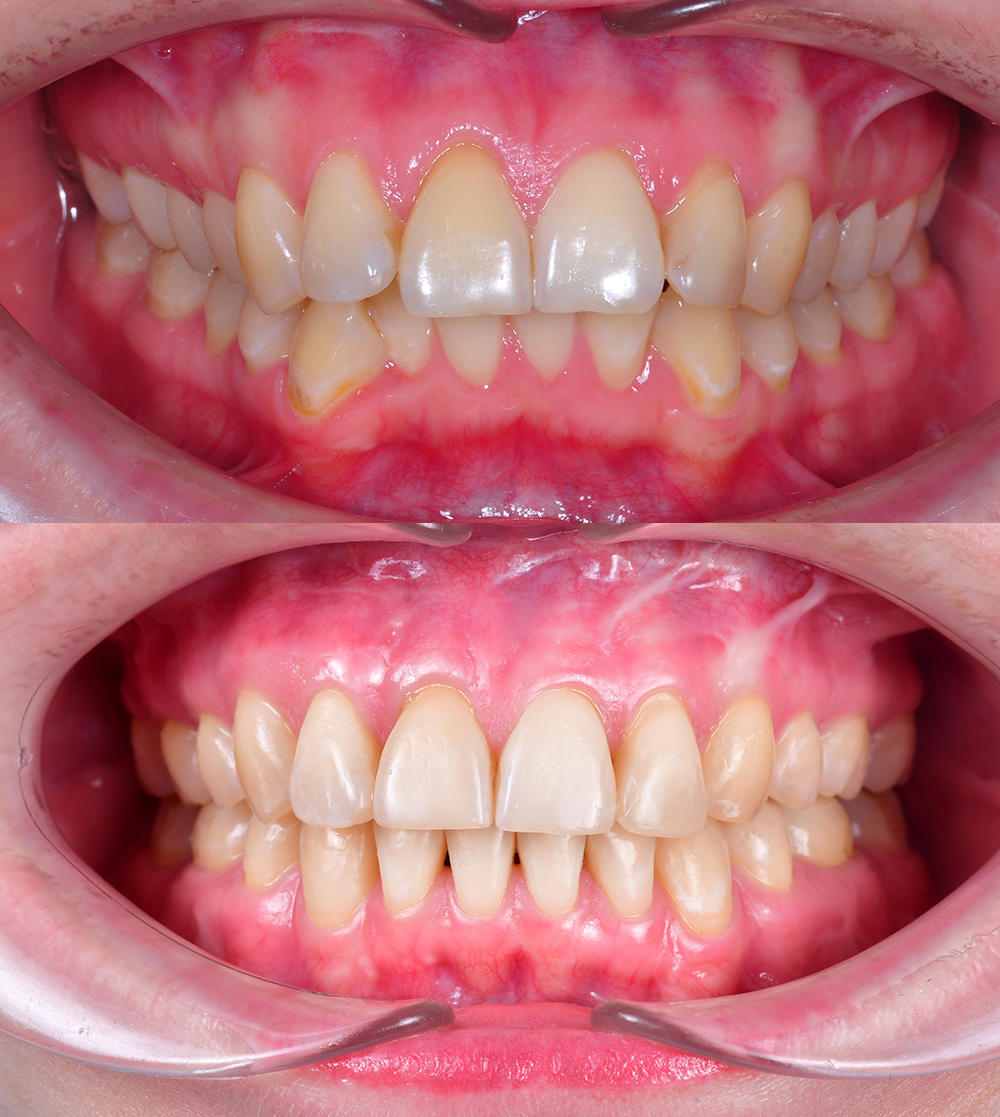 Лечение скелетной формы дистального смыкания с проведением ортогнатической двучелюстной хирургической операции